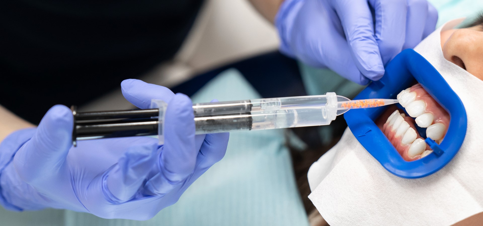 InOfficeBleaching Effektives Bleaching beim Zahnarzt